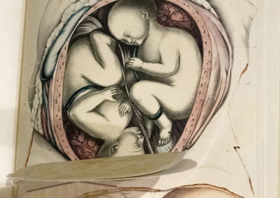 Obstetric tables by G. (George) Spratt